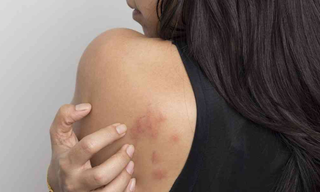 How Does Keloid Treatment Bring Back Smooth Skin Look?