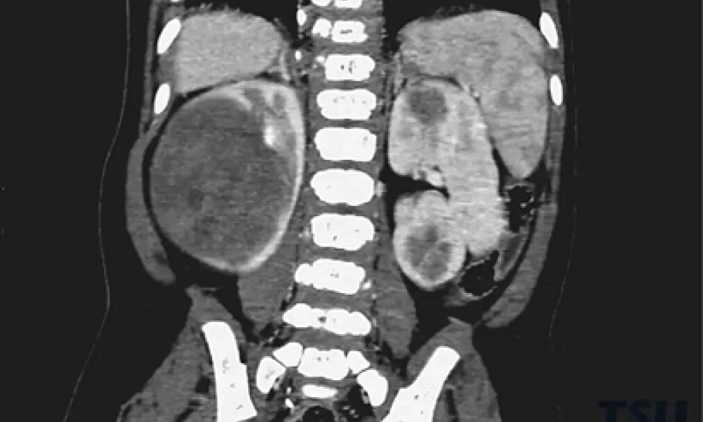 Top Guarding the Young Buds: A Century-long Battle to Conquer Childhood Nephroblastoma