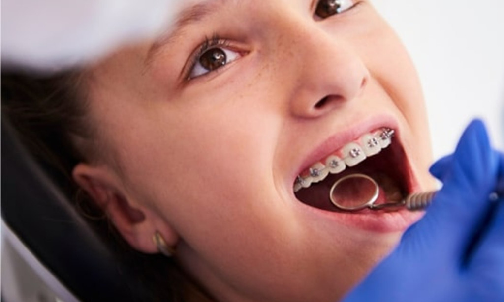 Achieve a Confident Smile with the Top Teeth Straightening in Adelaide at Dental Excellence