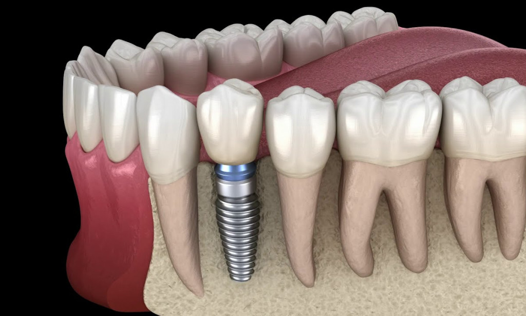 Top Benefits of Dental Implants in Glendale Heights for a Perfect Smile