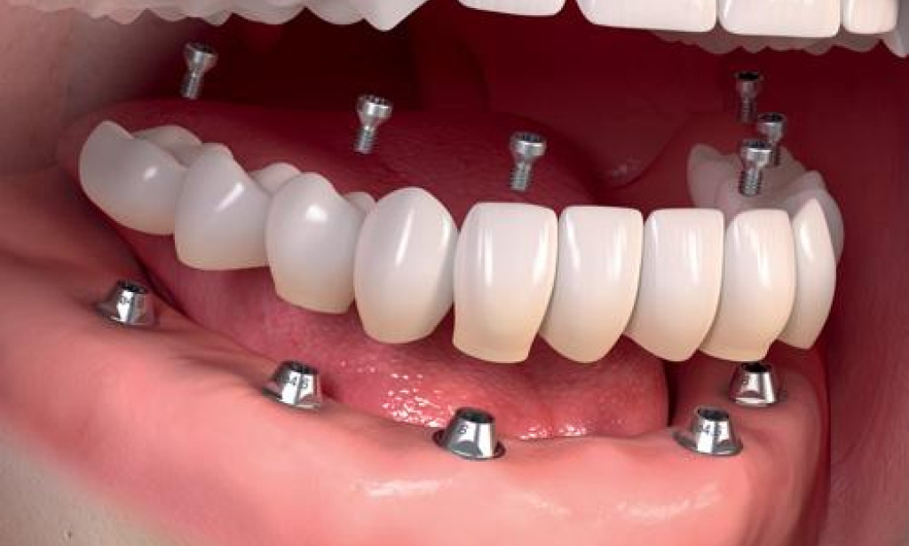 What Affects the Cost of Single Tooth vs Full Mouth Dental Implant: A Detailed Comparison