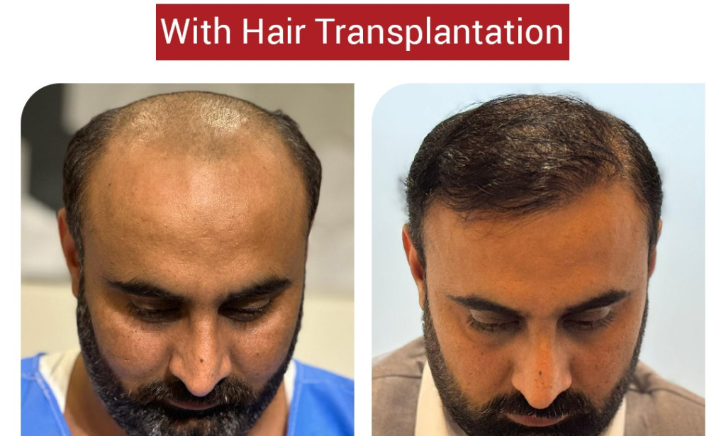 Top Hair clinic for hair loss