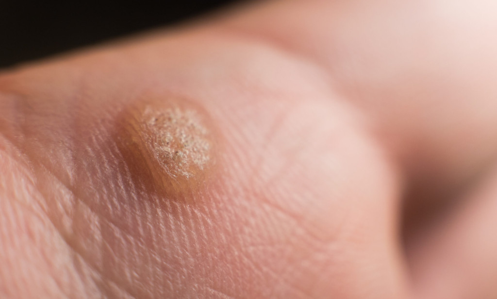 What Age Is Best for Warts Removal Treatment?
