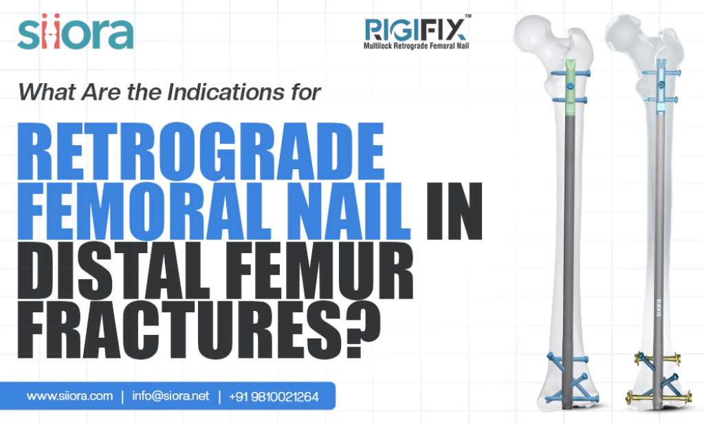 What Are the Indications for Retrograde Femoral Nail in Distal Femur Fractures?