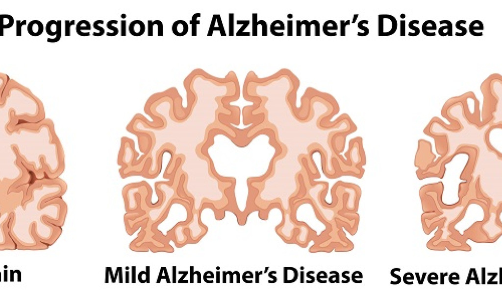 Top Central nervous system diseases