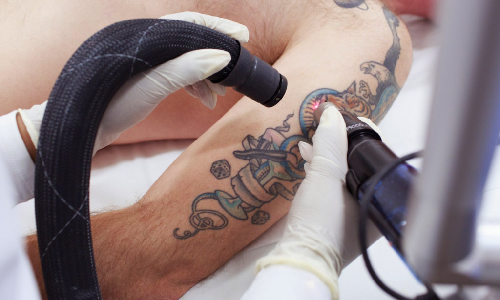 How Can Laser Tattoo Removal Treat Faded Ink Without Irritation?