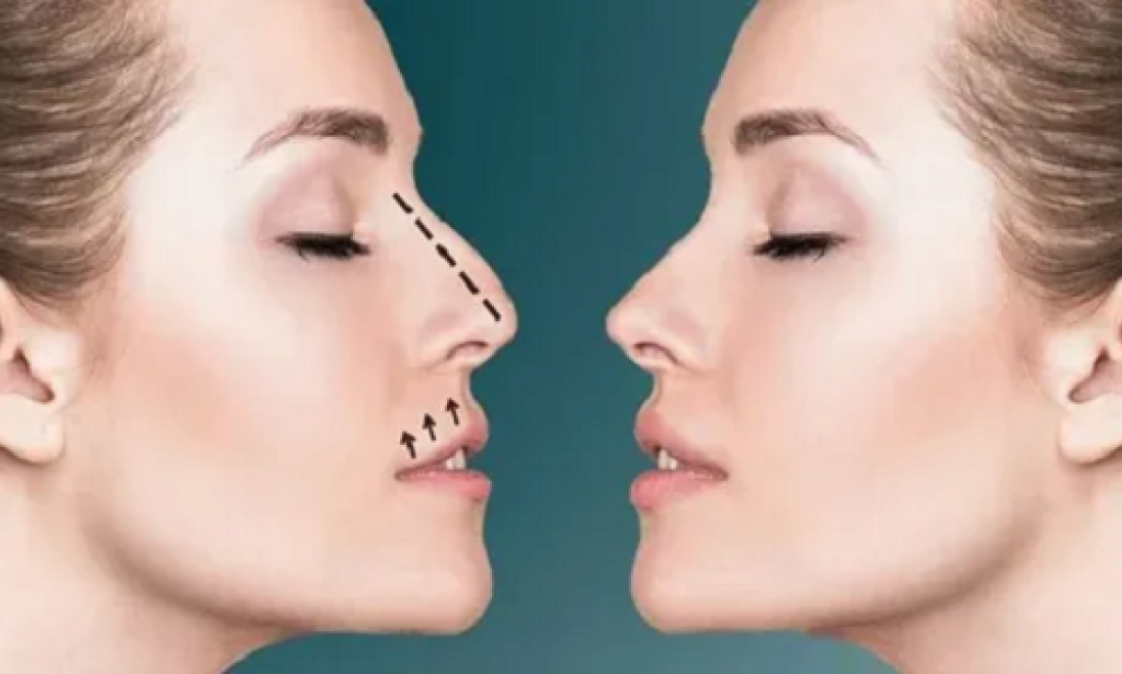 Rhinoplasty Dubai:What is Comprehensive Guide to Nose Reshaping