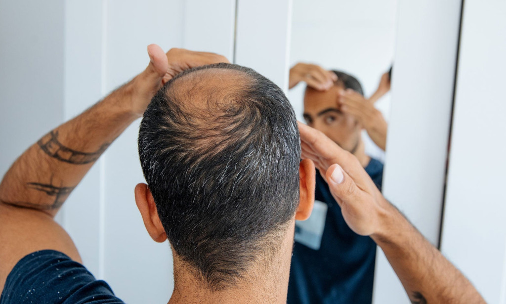 What to Expect from Hair Loss Treatment Sessions?