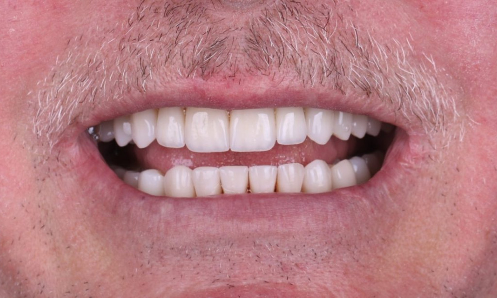 How Full Mouth Rehabilitation Improves Function and Aesthetics?