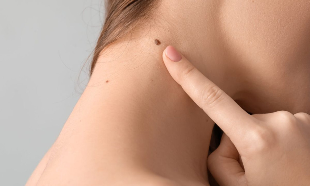 Mole Removal in Dubai: How a Comprehensive Guide to Clinical Precision