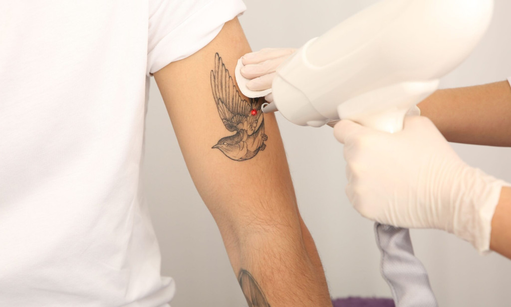 How does laser tattoo removal interact with tanning skin?