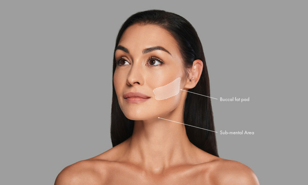 What to Expect from Buccal Fat Removal Surgery?
