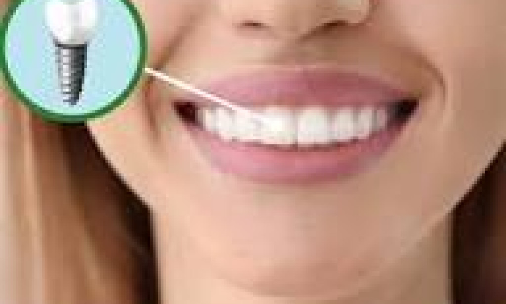 How a Dental Implant Specialist in Dombivli Can Permanently Fix Your Missing Teeth