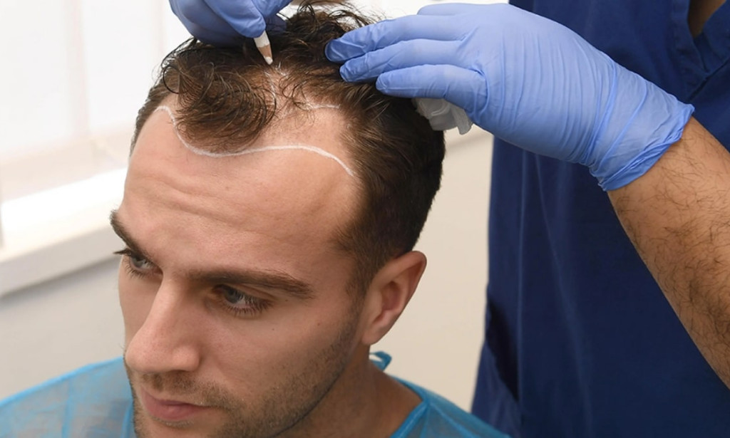 How Can Hair Transplant outperform temporary hair treatments?