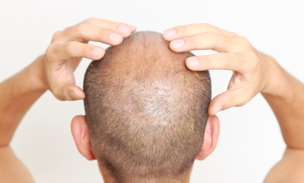 How Can Crown Hair Transplant Look Completely Undetectable Over Time?