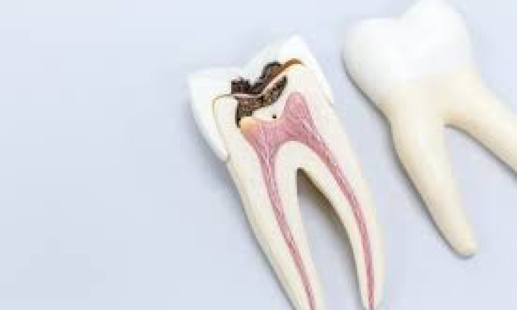 What Happens If You Choose Tooth Extraction Over Root Canal Treatment?