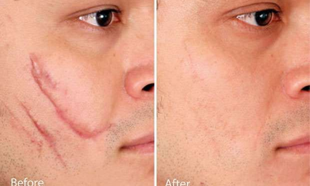 Scar Removal in Dubai: What are Advanced Methods for Injury Scars