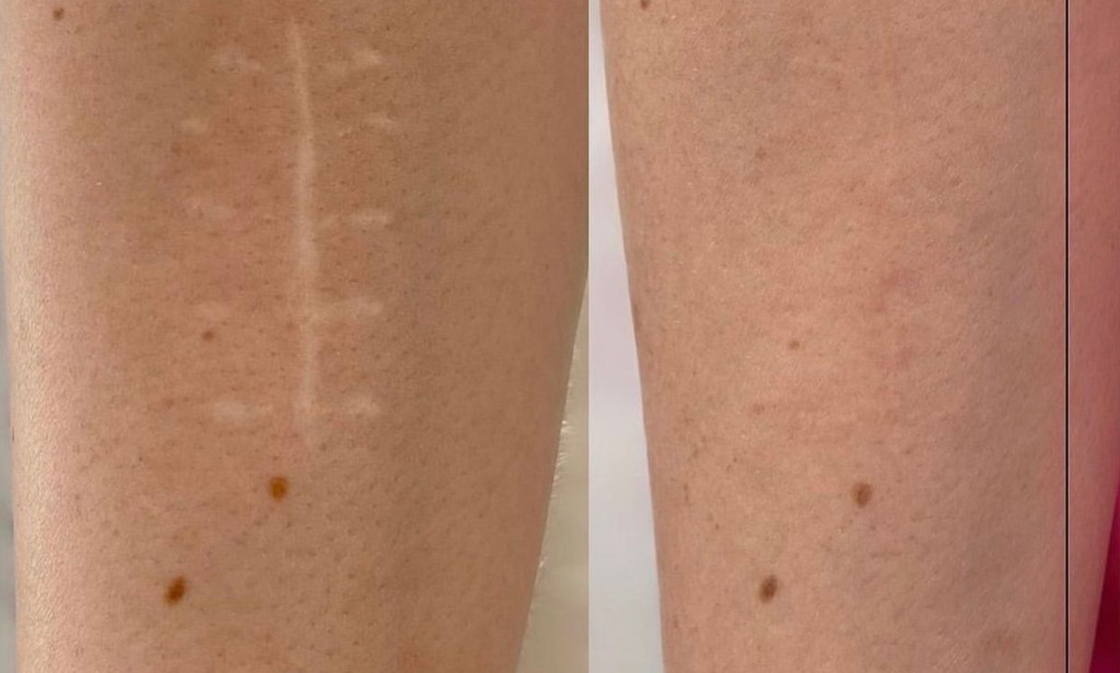 Scar Removal in Dubai:what is Professional Care for Tissue Repair