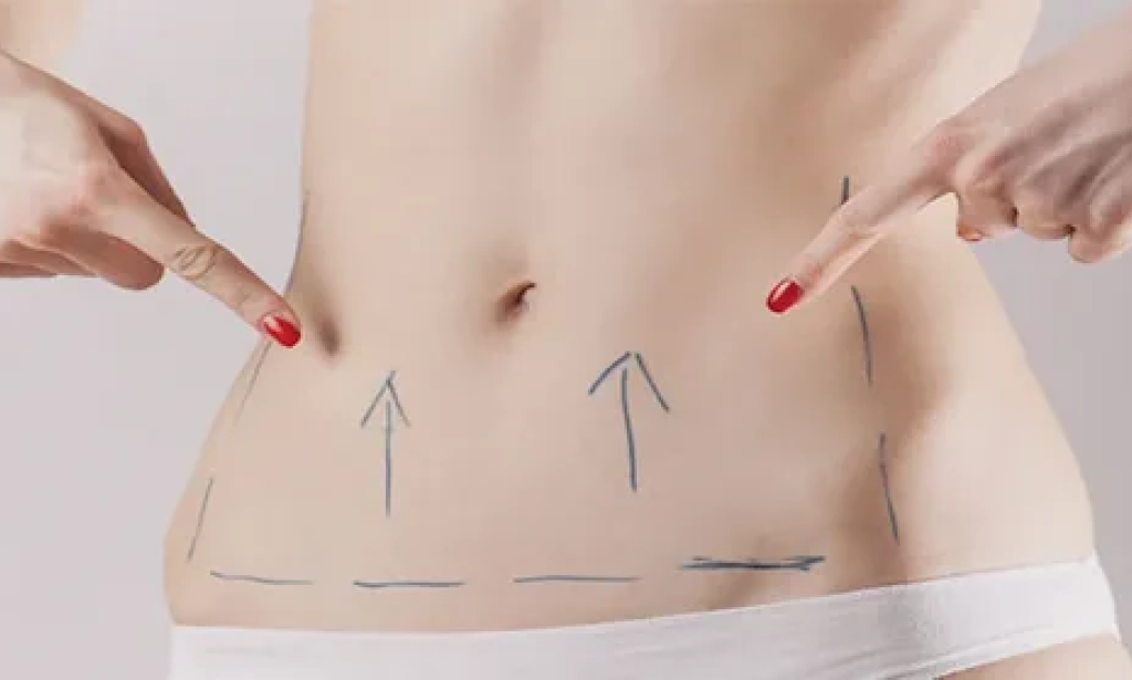 Tummy Tuck in Dubai: How to Define Your Waistline with Expertise