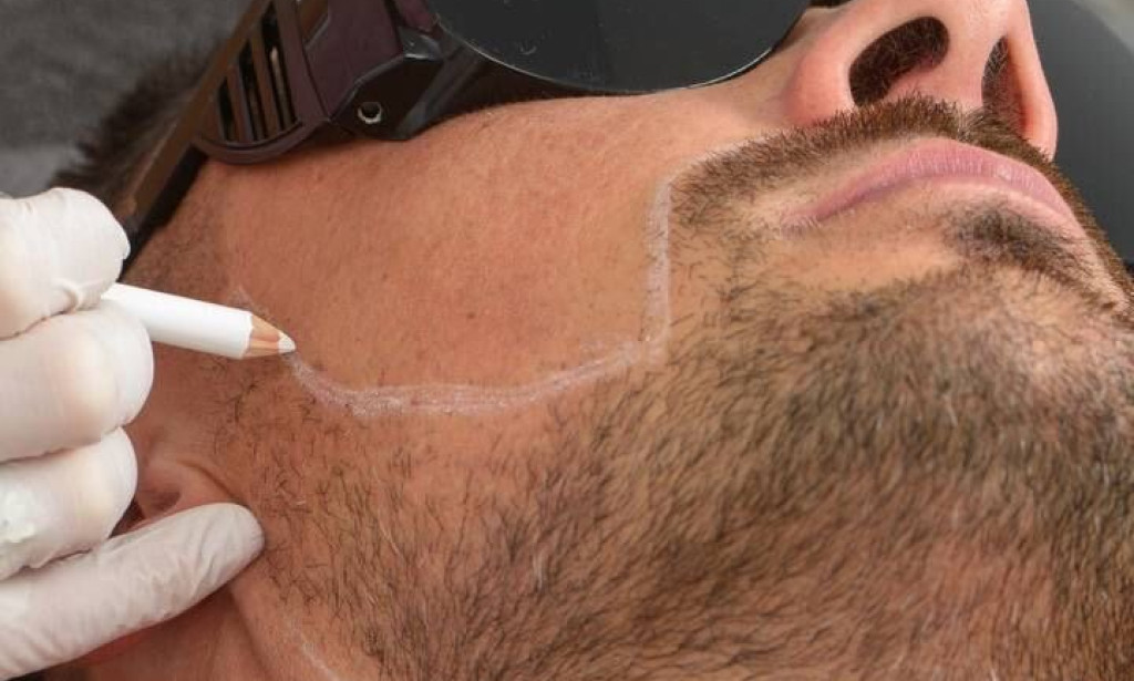 What Areas Do Men Commonly Treat With Laser Hair Removal?