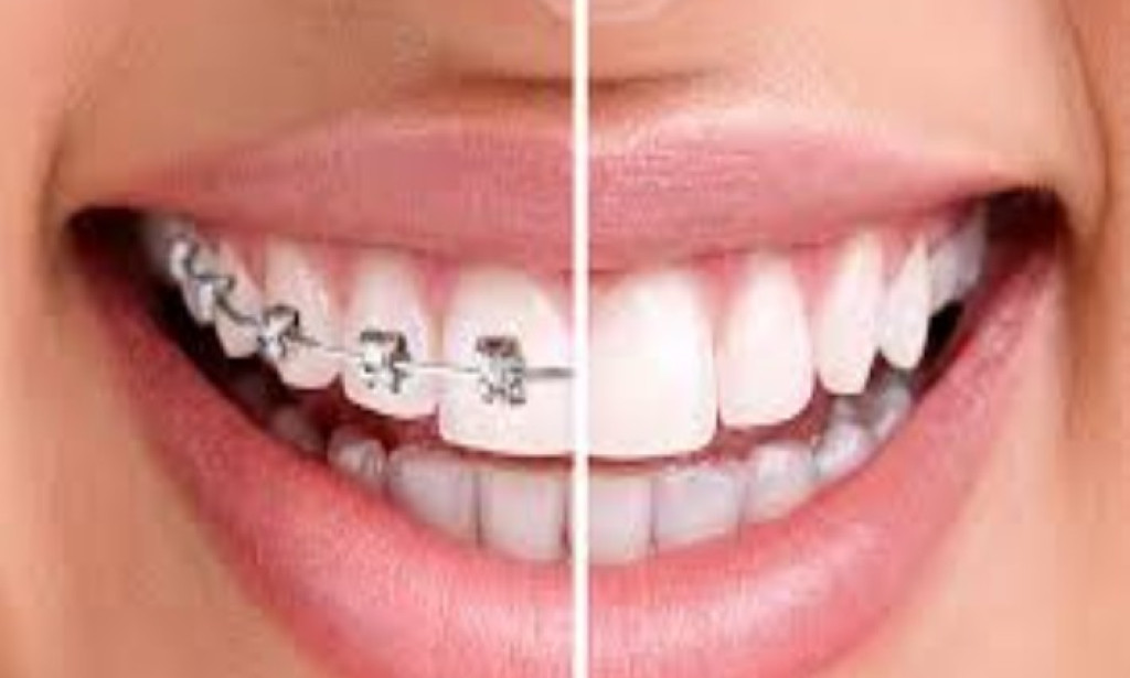 What Dental Braces Adelaide Can Do for Your Smile