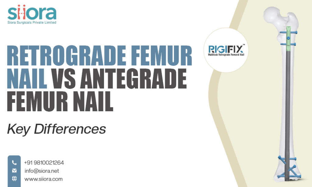 What Is Retrograde Femur Nail vs Antegrade Femur Nail: Key Differences