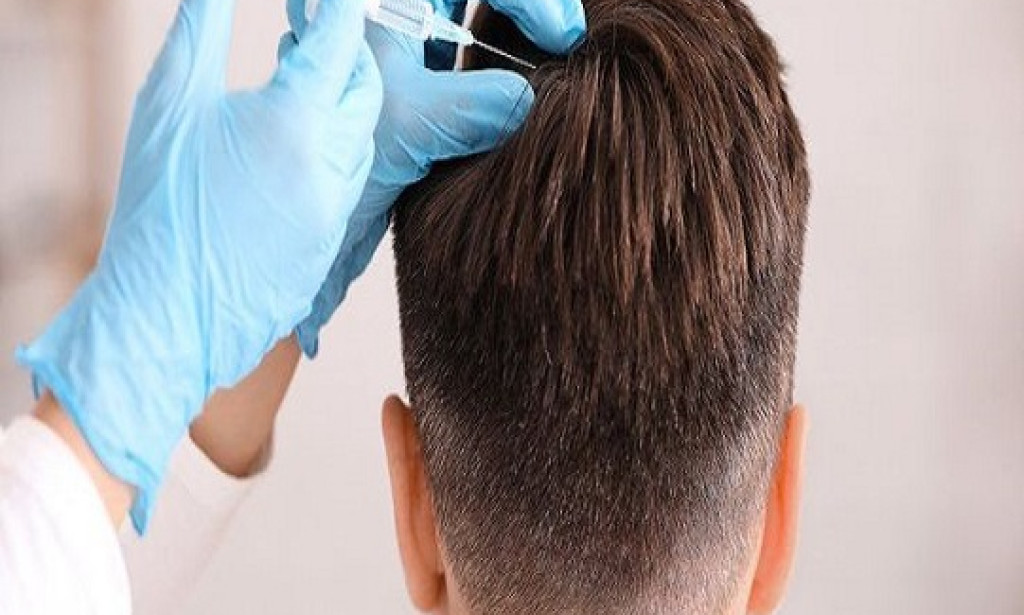 Hair Transplant in Dubai:What is A Comprehensive Guide for Patients