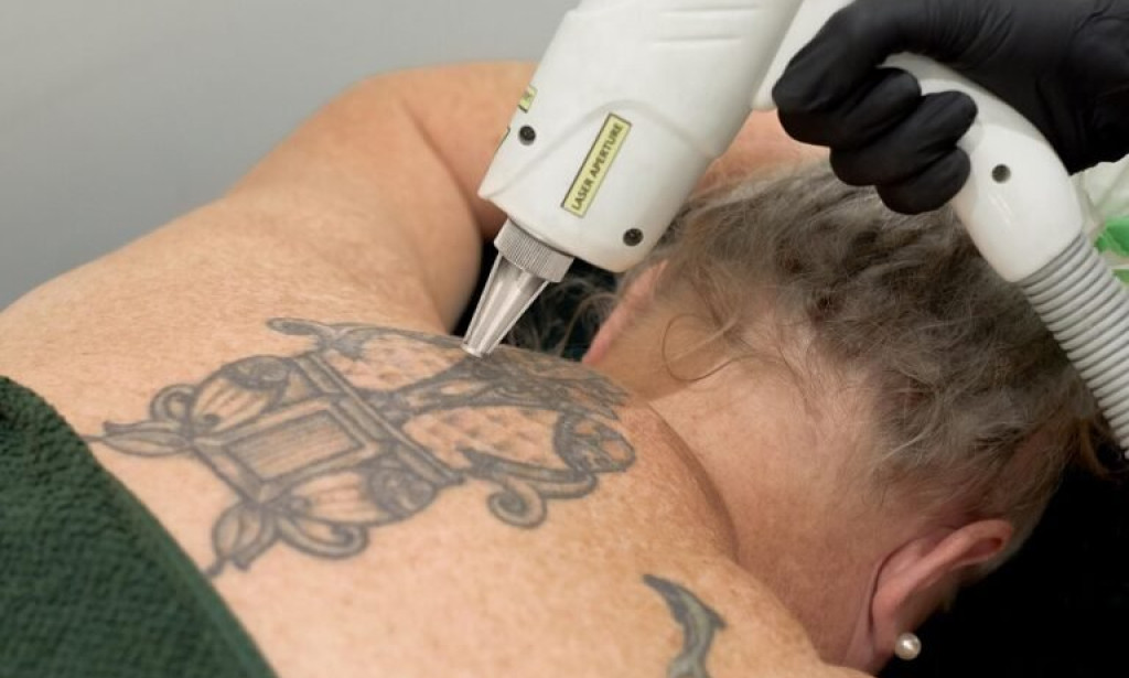 How Do Results Look After Laser Tattoo Removal Sessions?