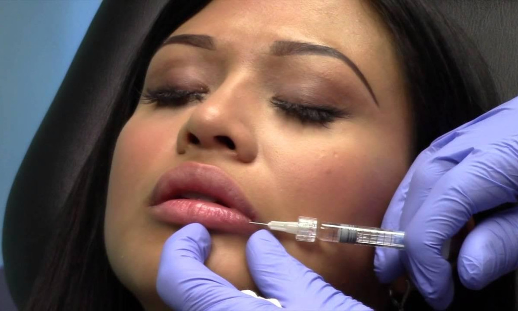 How Can a Lip Lift Enhance Natural Smile Without Overfilling Lips?