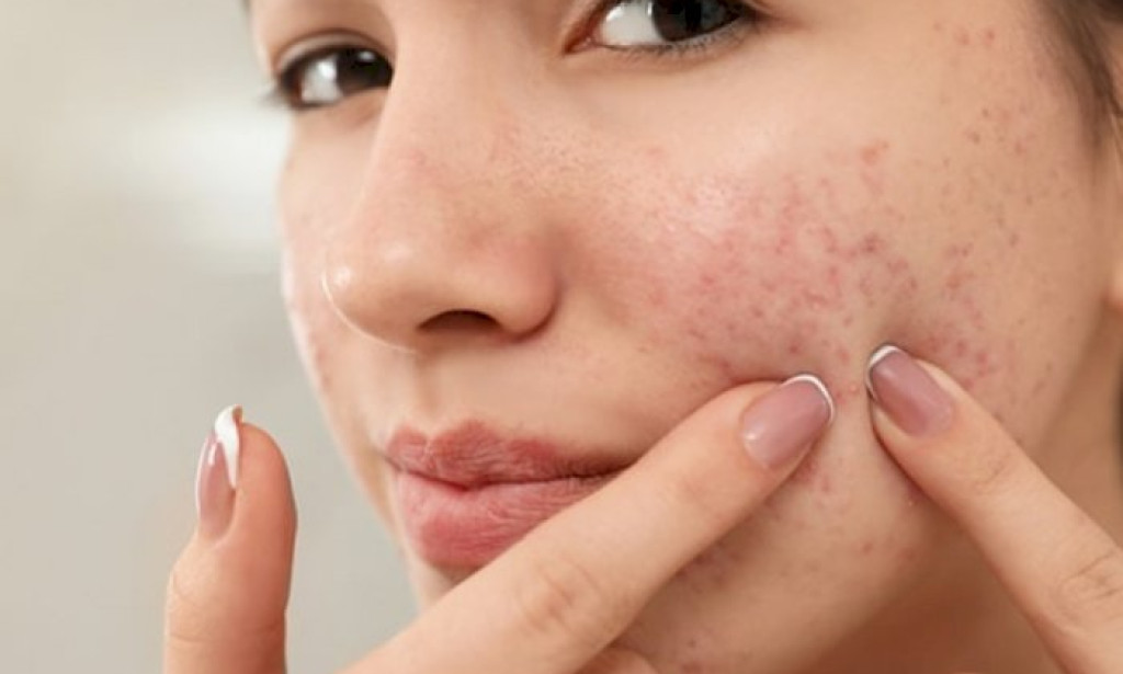 How Do You Choose the Best Acne Treatment for Your Skin Type?