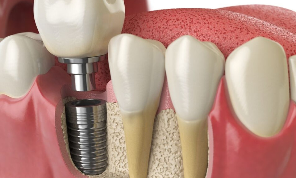 Top Things to Know Before Getting Dental Implants