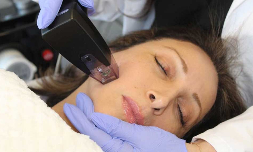 What Results Can You Expect From Morpheus8 Treatment?