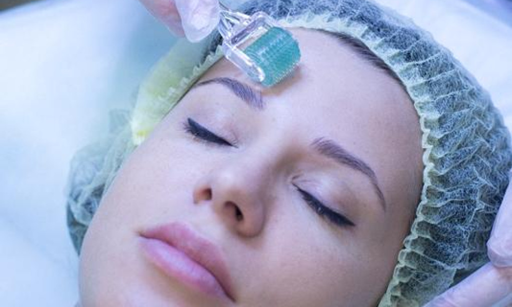 How Can Microneedling Improve Skin Stretch Damage Appearance?