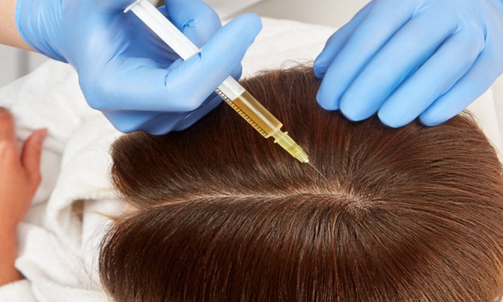 How to Transform Your Hair with Professional Hair Fillers in Dubai