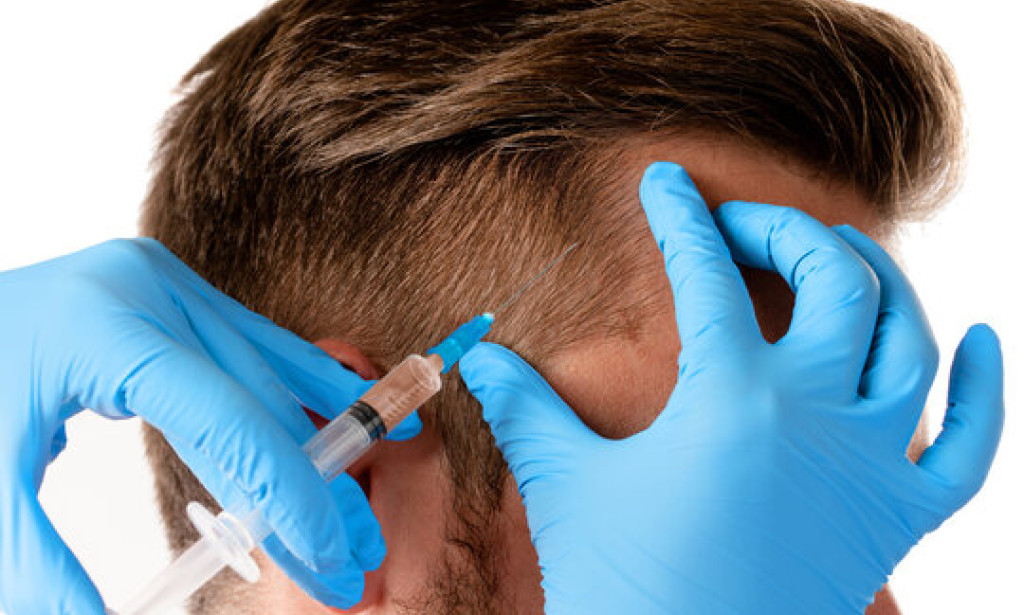 How Do I Get Fuller Hair With PRP Hair Treatment Sessions?