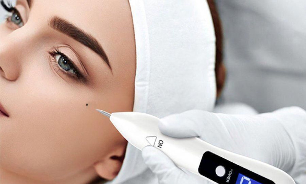 How to get Expert Mole Removal in Dubai for Clearer Skin