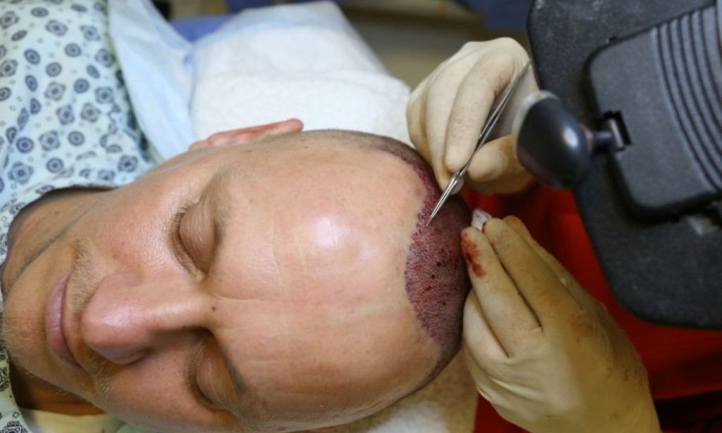 How Much Hair Coverage Can Hair Transplant Cost Provide?