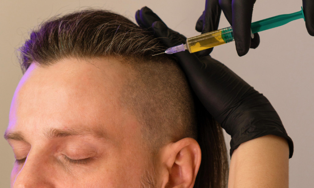 Frontal Hairline, Crown, Diffuse Thinning: Where PRP Hair Treatment in London Works Best