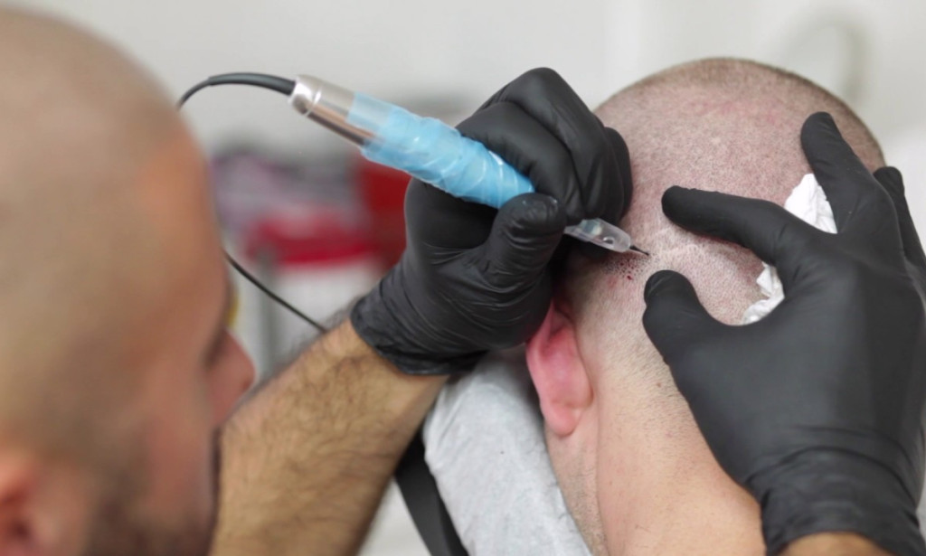 How Can FUSS Hair Transplant Fix Advanced Stage Hair Loss?