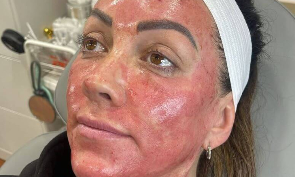 How Can Vampire Facial Refresh Tired Looking Facial Features?