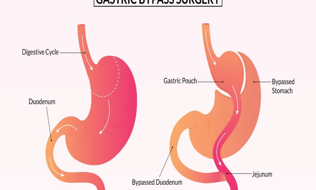 How Soon Do Gastric Bypass Results Become Visible?