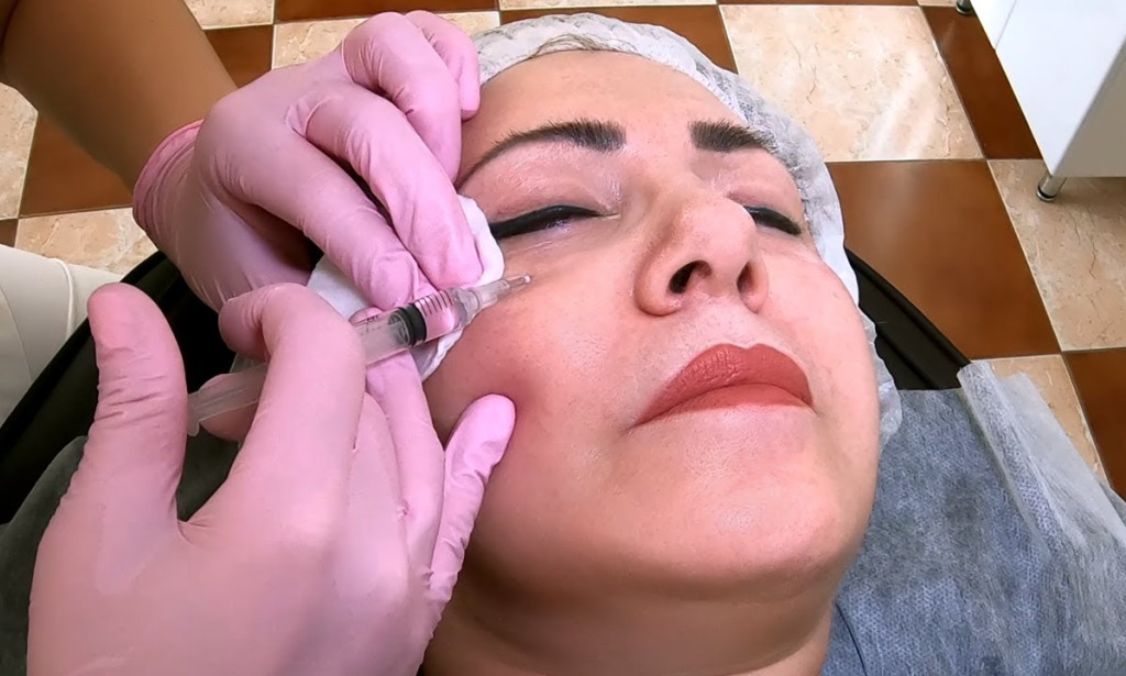 How Do Dermal Fillers Look Natural or Fake on the Face?