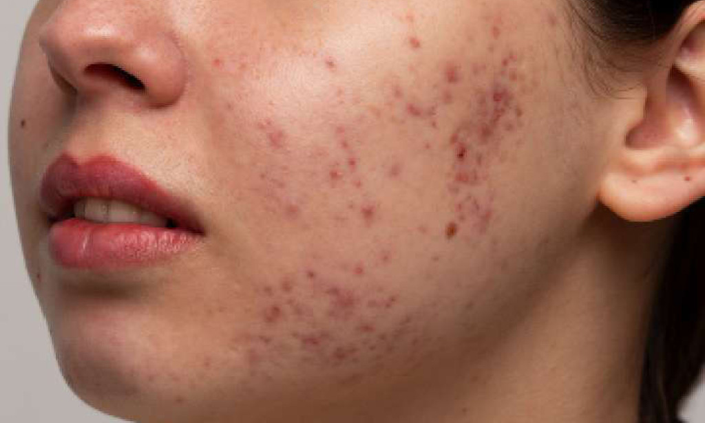 What Is the Best Dermatologist Treatment for Pimples?