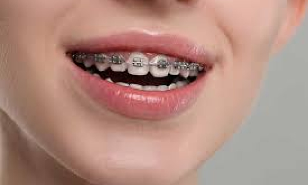 How Braces Treatment Improves More Than Just Your Smile