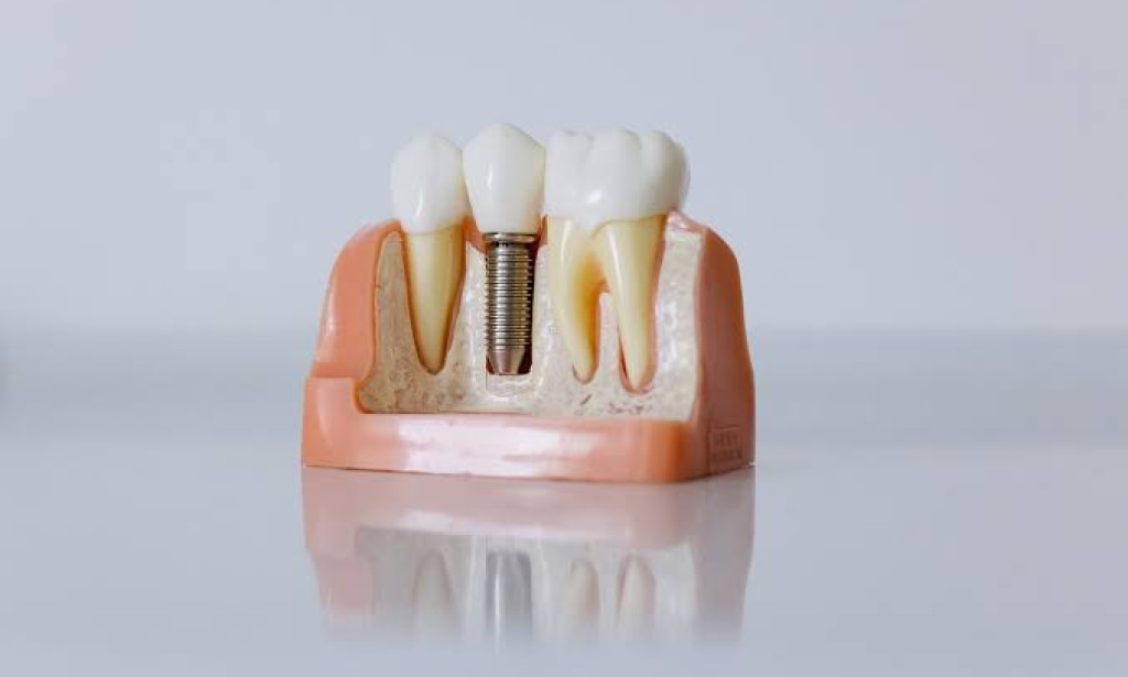 Dental Implants: Causes, Benefits & What Patients Should Know Before Treatment