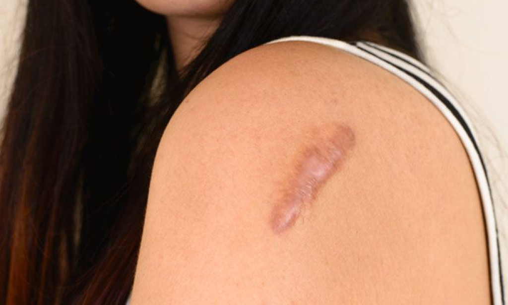 How Can Keloid Treatment Prevent Scar Recurrence?