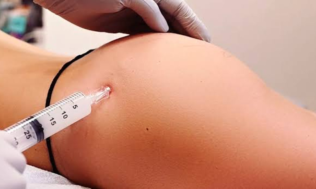 How Butt Fillers Support Shape Enhancement Principles