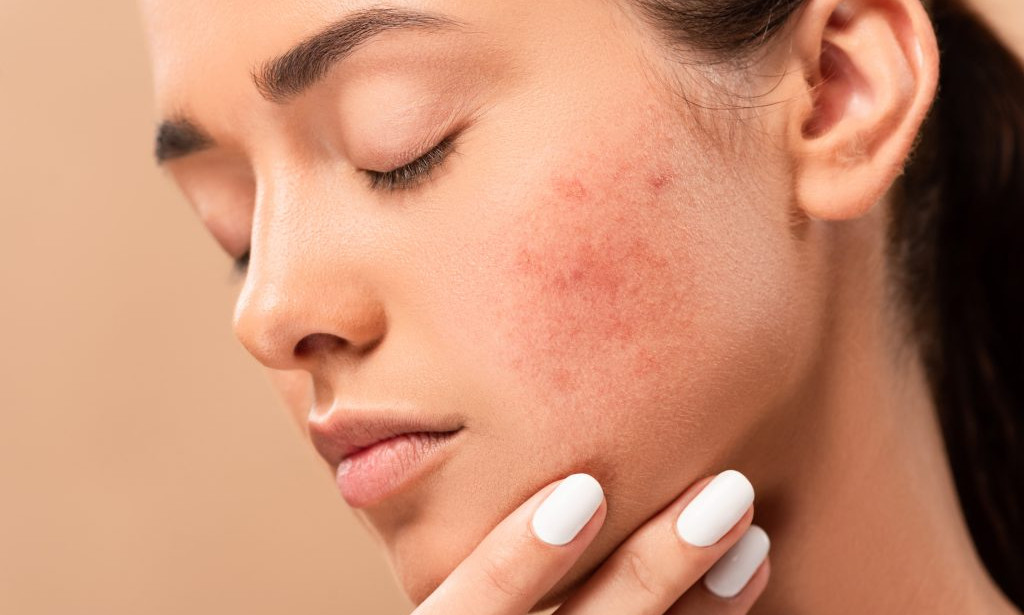 Is top 3 Acne Scar Treatments Right for All Scar Types?