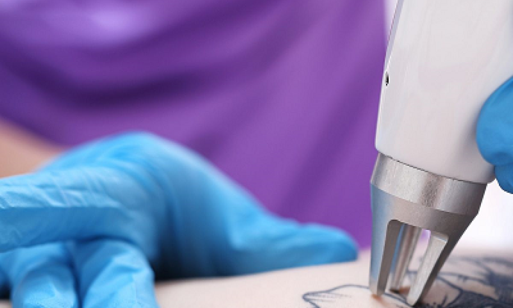 Tattoo removal in dubai:How Professional Skin Restoration