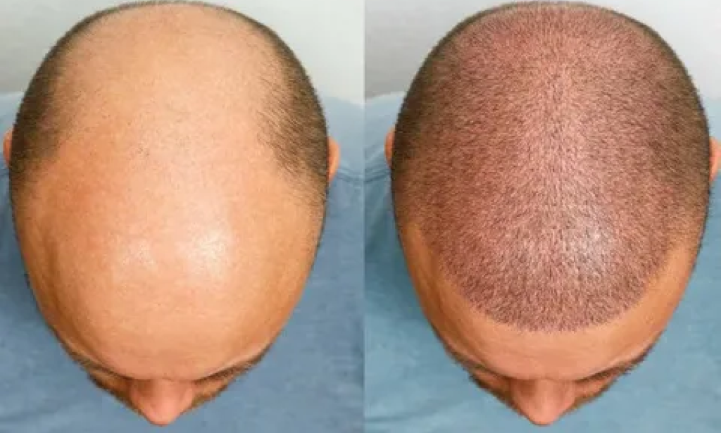 How ro get 1 Dirham Hair Transplant in Dubai: A Realistic Guide
